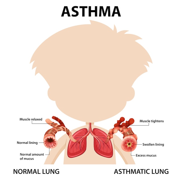 Free Vector bronchial asthma diagram with normal lung and asthmatic lung