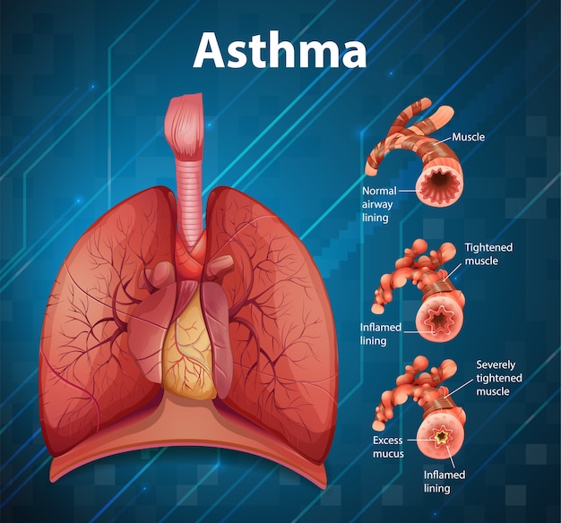 Free Vector comparison of healthy lung and asthmatic lung