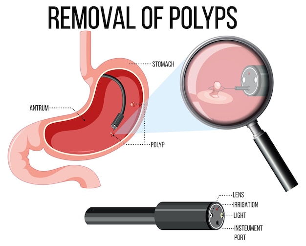 Free Vector diagram showing removal of polyps