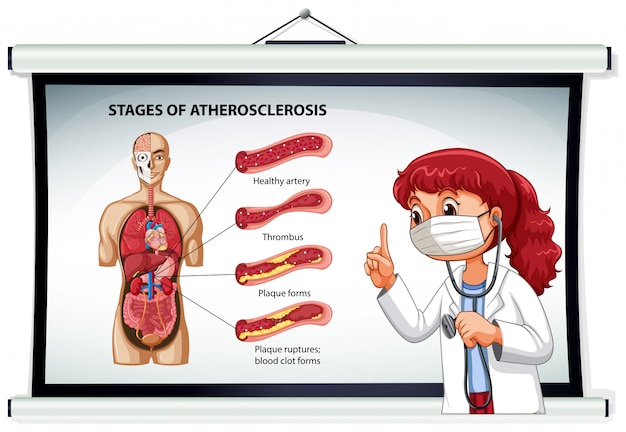 Free Vector doctor explaining stages of atherosclerosis
