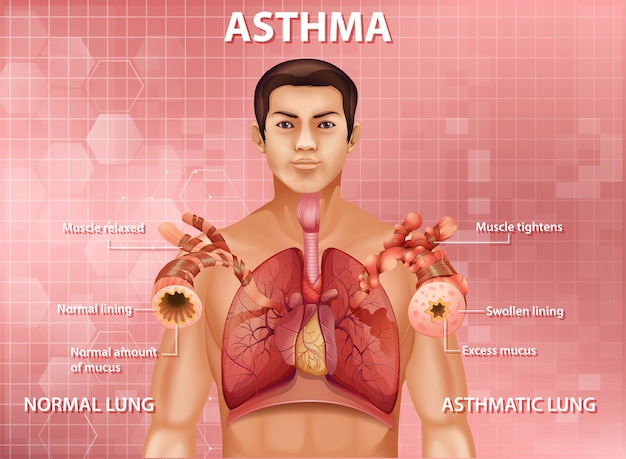 Free Vector human anatomy asthma diagram