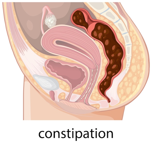 Free Vector human digestive system with constipation illustration