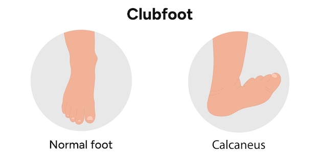Vector clubfoot