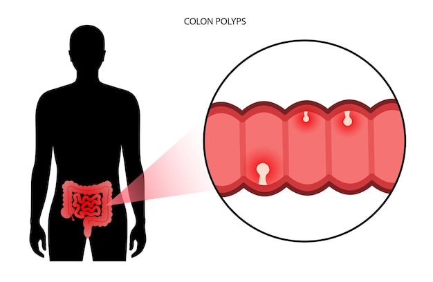 Vector colon polyps inflammation