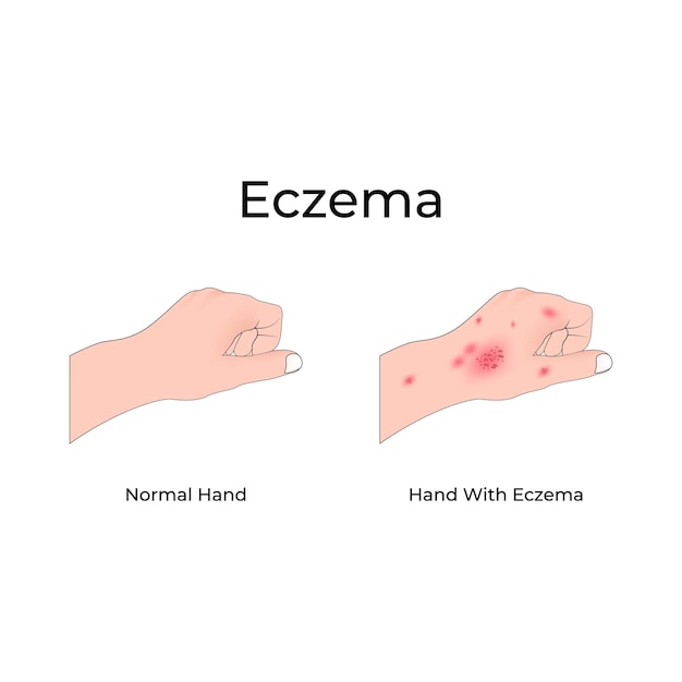 Vector eczema on hand design vector illustration