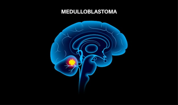 Vector medulloblastoma brain cancer