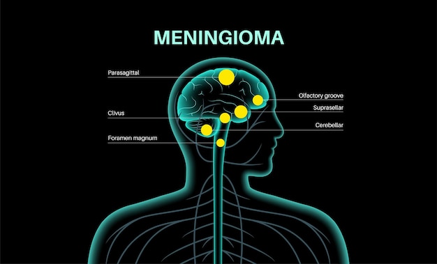 Vector meningiomas cancer poster