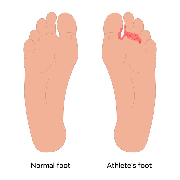 Vector normal and athletes foot