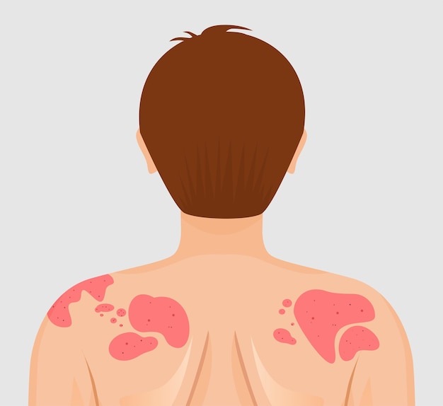 Vector psoriasis on back