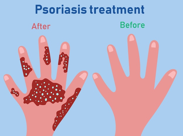 Vector stages psoriasis formation