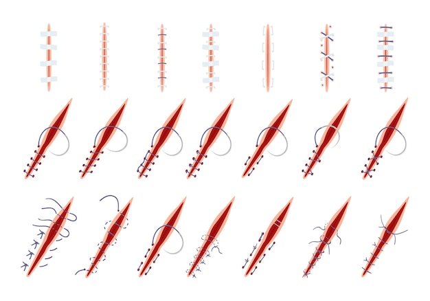 Vector suture icons set cartoon vector wound surgical