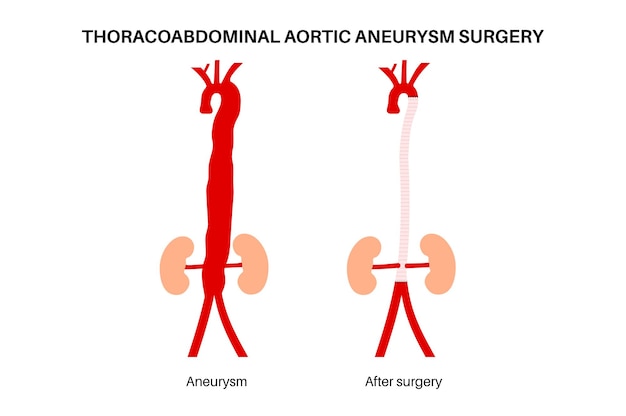 Vector thoracoabdominal aortic aneurysm surgery