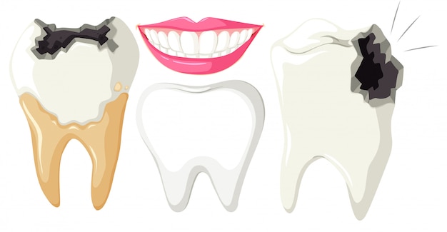 Vector tooth decay on white background
