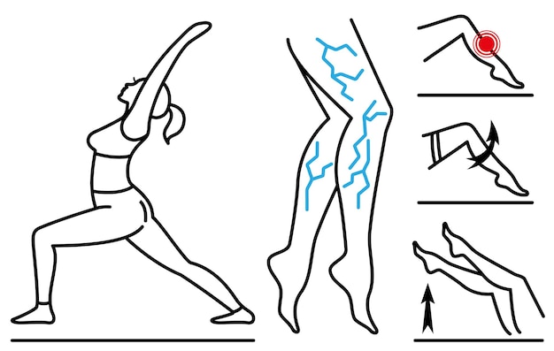Vector varicose veins prevention and management exercise and symptoms